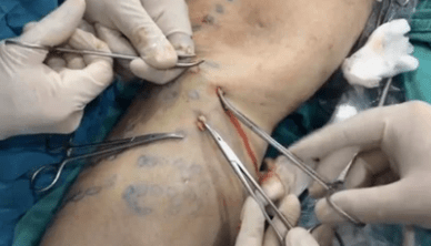 Kako se izvodi flebetomija za uklanjanje proširenih vena