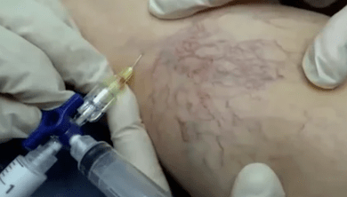 skleroterapija proširenih vena