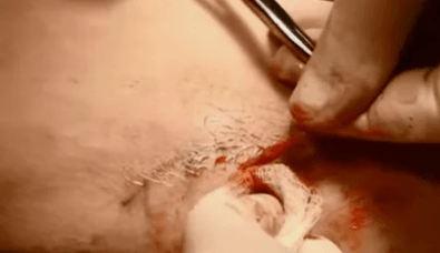 vrste operacija za uklanjanje proširenih vena